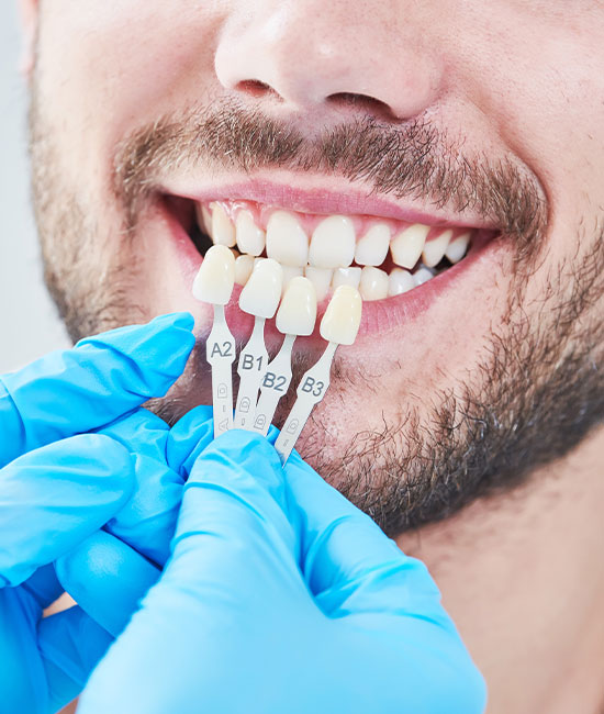 The image shows a person with a full set of teeth being fitted for dental implants, as indicated by the presence of implant abutments and a dentist s hand holding a dental tray.